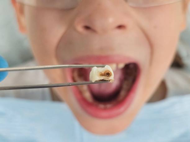 Best Emergency Tooth Extraction in Saugerties South, NY